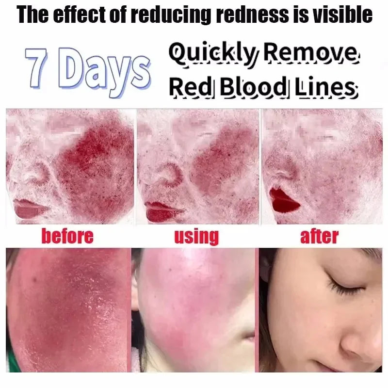 Facial Redness Repair Cream Improve Sensitive Muscles Acne Rosacea Dry&Itchy Skin Moisturizer Lotion Korean skincare products