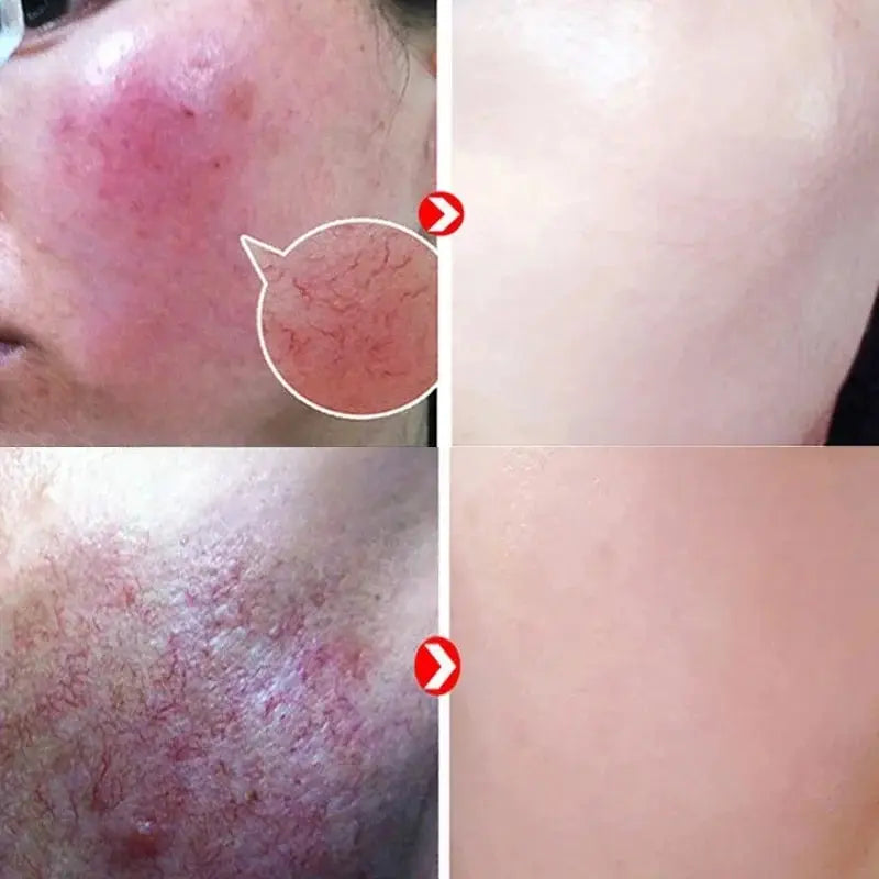 Facial Redness Repair Cream Improve Sensitive Muscles Acne Rosacea Dry&Itchy Skin Moisturizer Lotion Korean skincare products