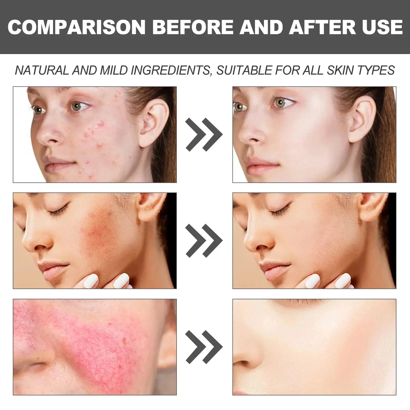 Facial Redness Repair Cream Improve Sensitive Muscles Acne Rosacea Dry&Itchy Skin Moisturizer Lotion Korean skincare products