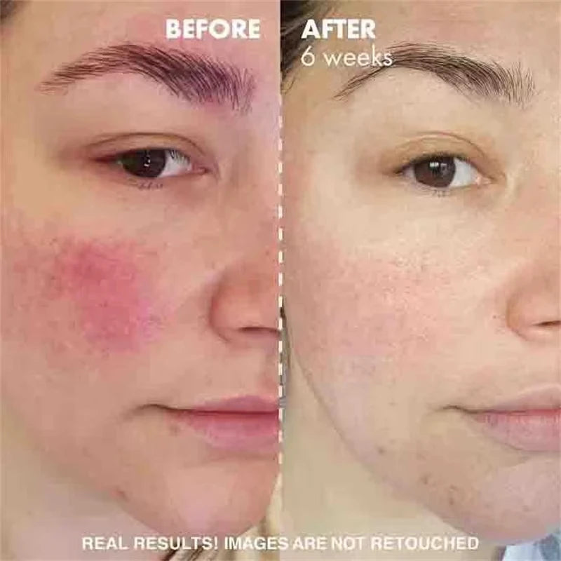Facial Redness Repair Cream Improve Sensitive Muscles Acne Rosacea Dry&Itchy Skin Moisturizer Lotion Korean skincare products